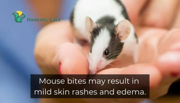 Mouse bites may result in mild skin rashes and edema.