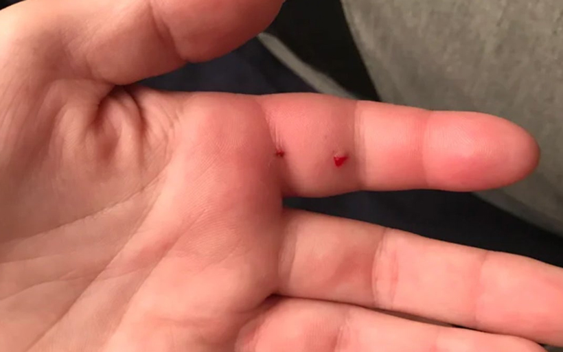 Mouse Bite Treatment at Home